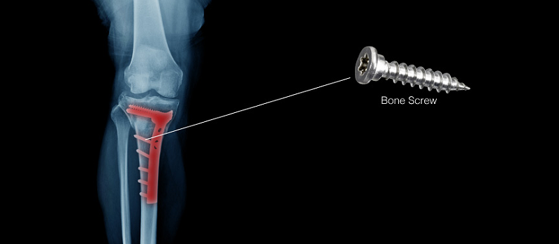 医疗骨钉加工<a href='/gaosuzhuzhou.htm' class='keys' title='点击查看关于高速主轴的相关信息' target='_blank'>高速主轴</a>.png